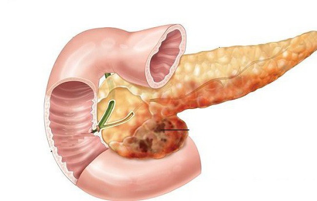 Sốt, đau bụng đi kèm các dấu hiệu này: Hãy cảnh giác cao độ với bệnh ung thư tuyến tụy