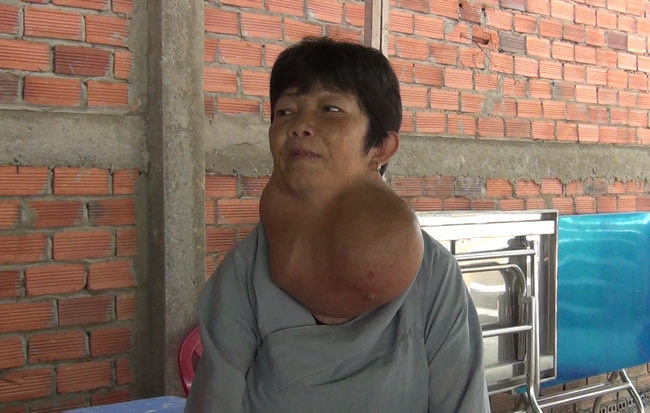Người phụ nữ ở Tiền Giang mang bướu cổ "khủng" 5 kg gần 30 năm