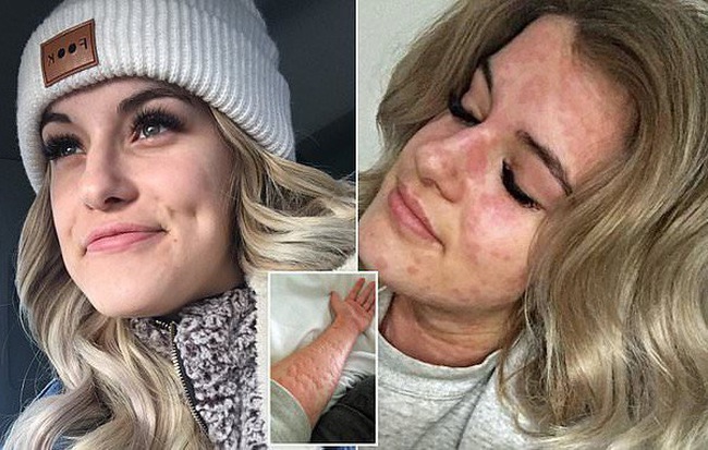 Cô gái 21 tuổi và chứng "dị ứng mùa đông" kỳ lạ: Hễ nhiễm lạnh là nổi mề đay, có thể tử vong vì ngạt thở