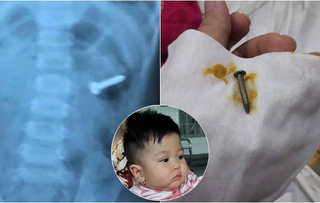 Anh trai 2 tuổi đút cho em ăn, mẹ thấy con ọe tức tốc đưa đi viện và hốt hoảng khi nhìn kết quả X-quang
