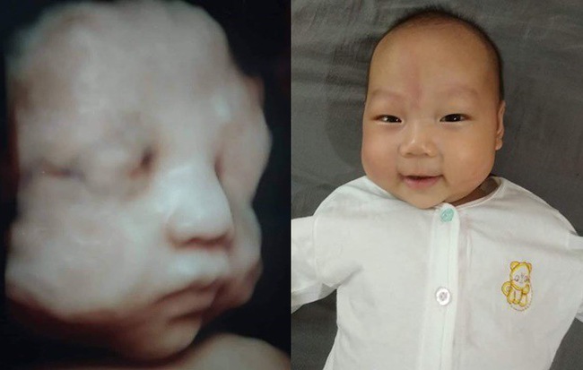 Hành trình giữ con kì diệu của mẹ Hà Nội khi thai nhi bị tràn dịch màng phổi, màng bụng và phù thai