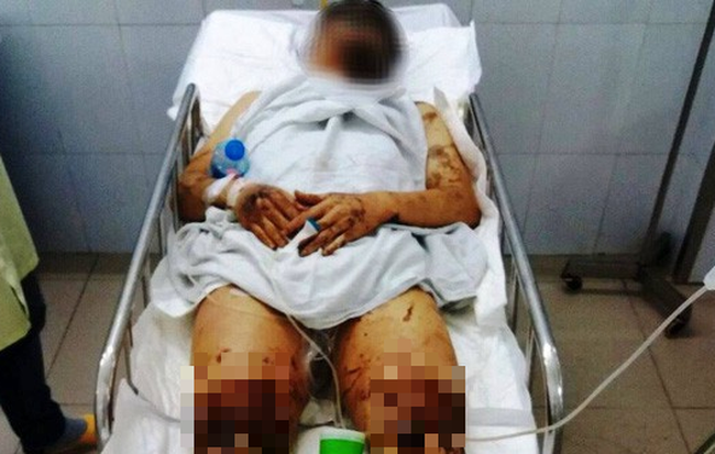Thông tin mới nhất vụ Việt kiều về quê ăn tết bị tạt axit, cắt gân chân