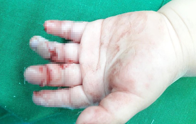 Bé 16 tháng bị dập 3 ngón tay vì thò vào máy xay thịt của gia đình