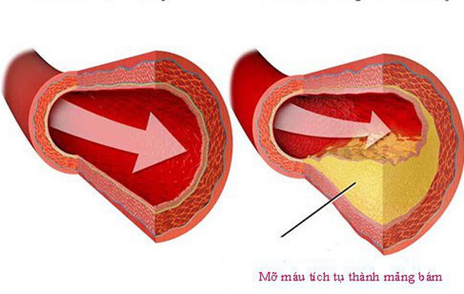 Bệnh mỡ máu cao "không trừ một ai": Muốn không có bệnh thì nên chú ý 7 điều quan trọng