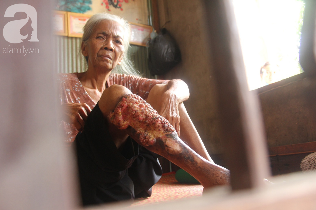 Lời khẩn cầu của người bà 70 tuổi mù một bên mắt, chân bị hoại tử, thối rữa nặng mà không có tiền phẫu thuật