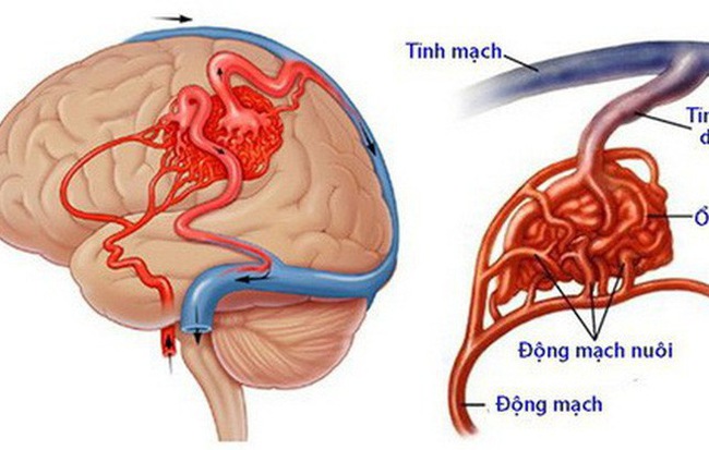 Đang dự thi, thí sinh Hà Tĩnh đột ngột liệt nửa người: Căn bệnh nguy hiểm thế nào?