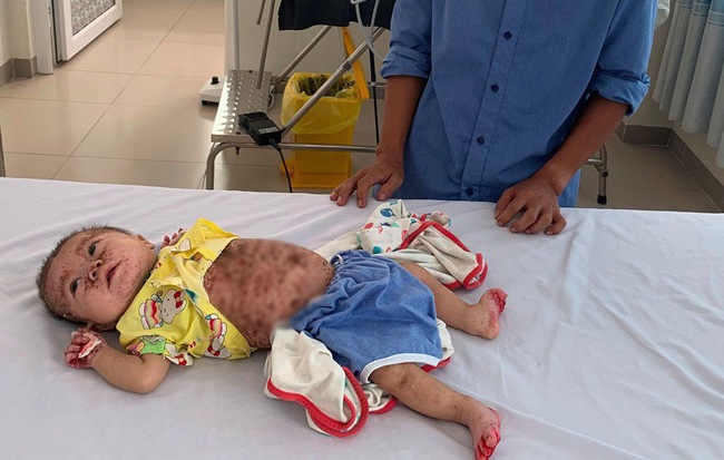 Xót xa bé gái 5 tháng tuổi bị viêm da bội nhiễm nặng, lở tróc khắp người vô cùng đau đớn