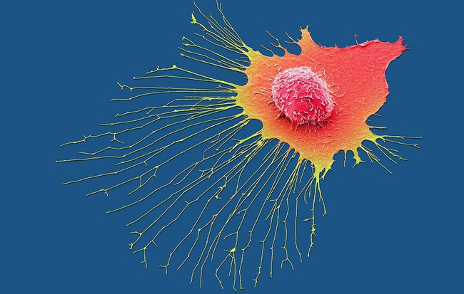 5 việc mà nhiều người đang làm hàng ngày chính là cách "nuôi" tế bào ung thư lớn lên