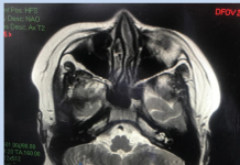 TP HCM: Hậu COVID-19, trẻ 13 tuổi bị viêm đa hệ thống tổn thương não